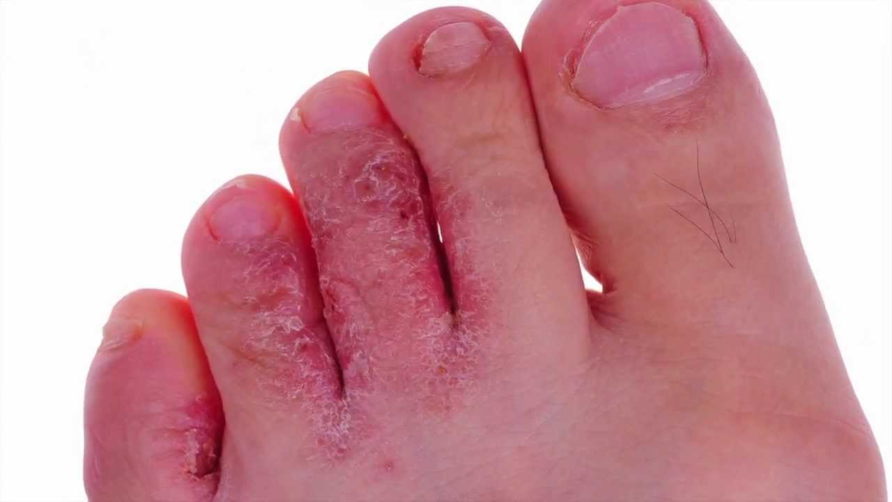 Опрелости между пальцами ног: лечение у мужчин и женщин