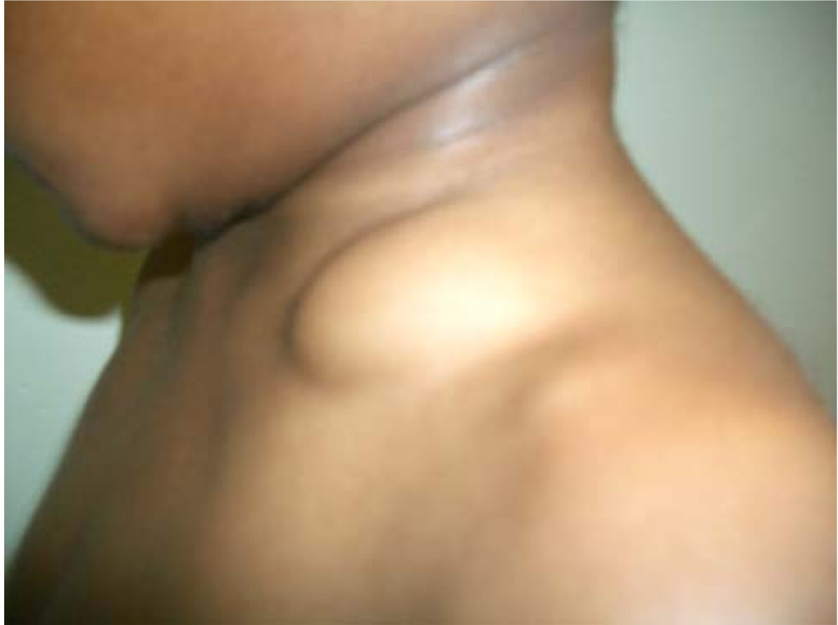 подкожное уплотнение на груди у мужчин фото 54