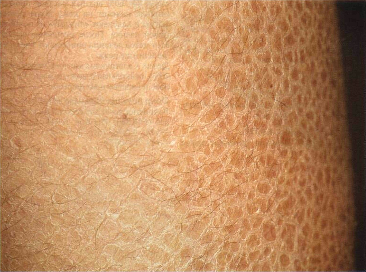 дерматит высыпания в паховой области лечение фото