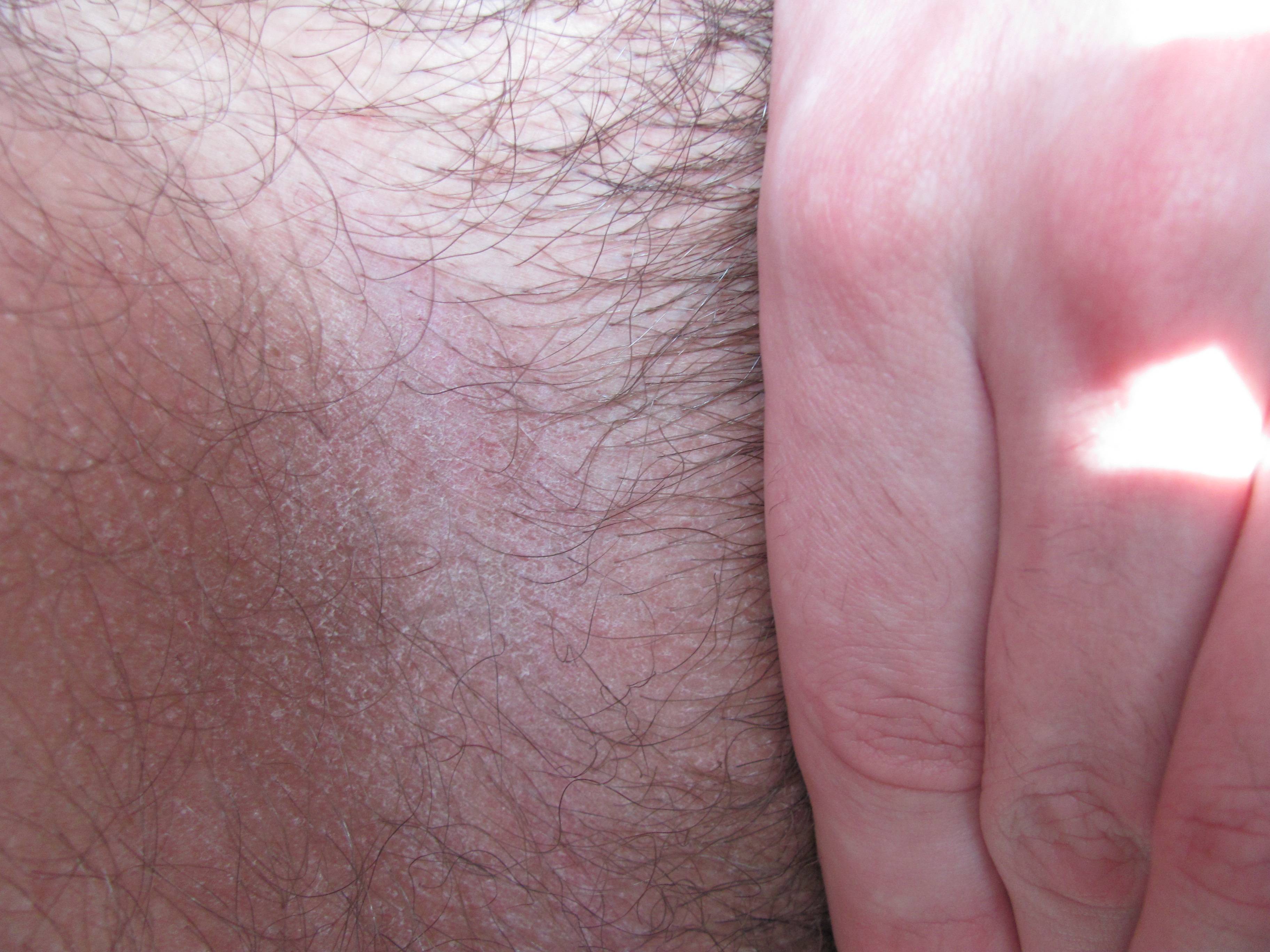 грибок на члене у мужчин лечение фото 52